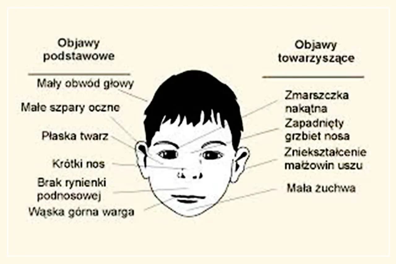 Jak wygląda dziecko z FAS? Poznaj charakterystyczne cechy i objawy