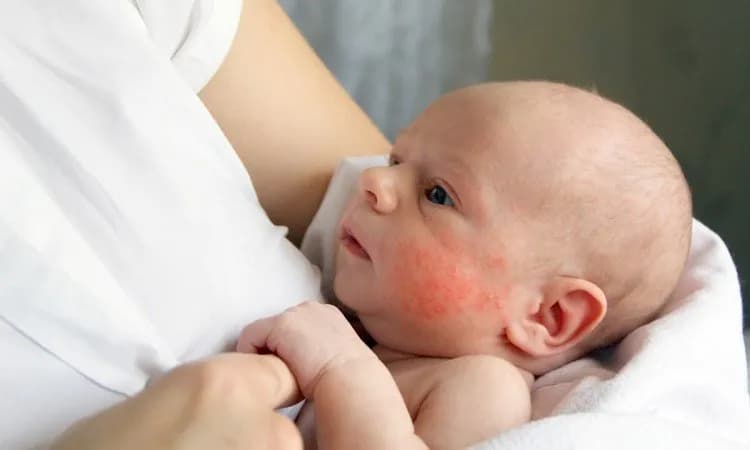 Rumień zakaźny kiedy do przedszkola - ważne informacje dla rodziców